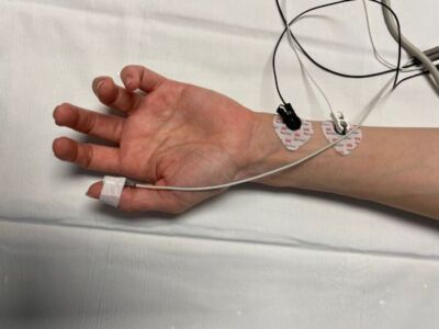 Peripheral Nerve Stimulator - Train of Four Monitoring: Overview