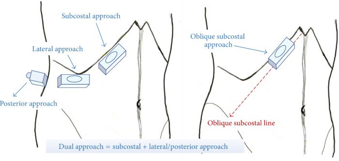 Anatomical variations of the thoracolumbar nerves with reference to  transverse abdominal plane (TAP) block