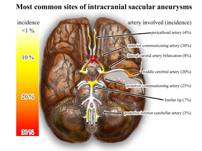 Subarachnoid Hemorrhage
