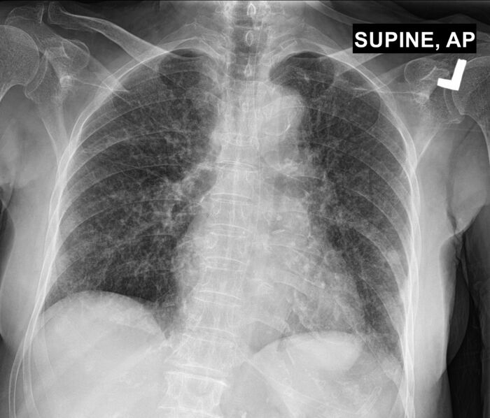 Pulmonary Aspiration: Diagnosis, Complications & Treatment