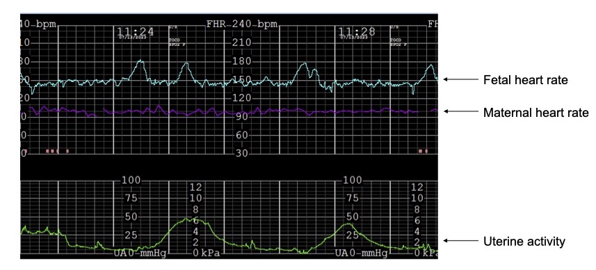 Fetal heart rate monitoring