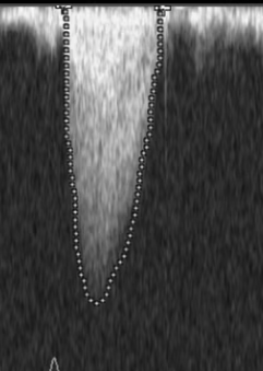 Bicuspid Aortic Valve Disease Openanesthesia Bicuspid Aortic Valve Disease Openanesthesia