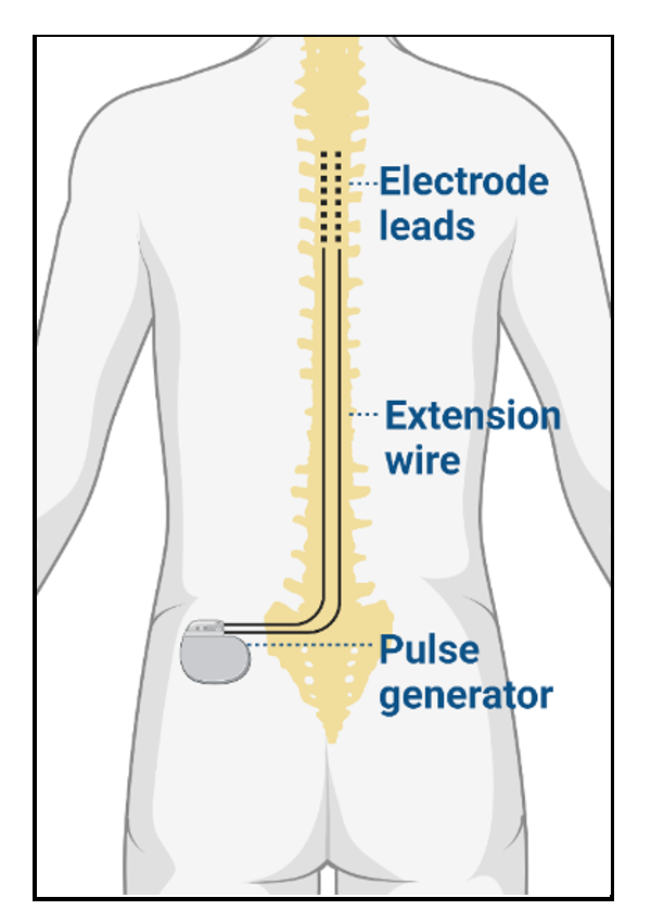 Spinal Cord Stimulation - OpenAnesthesia